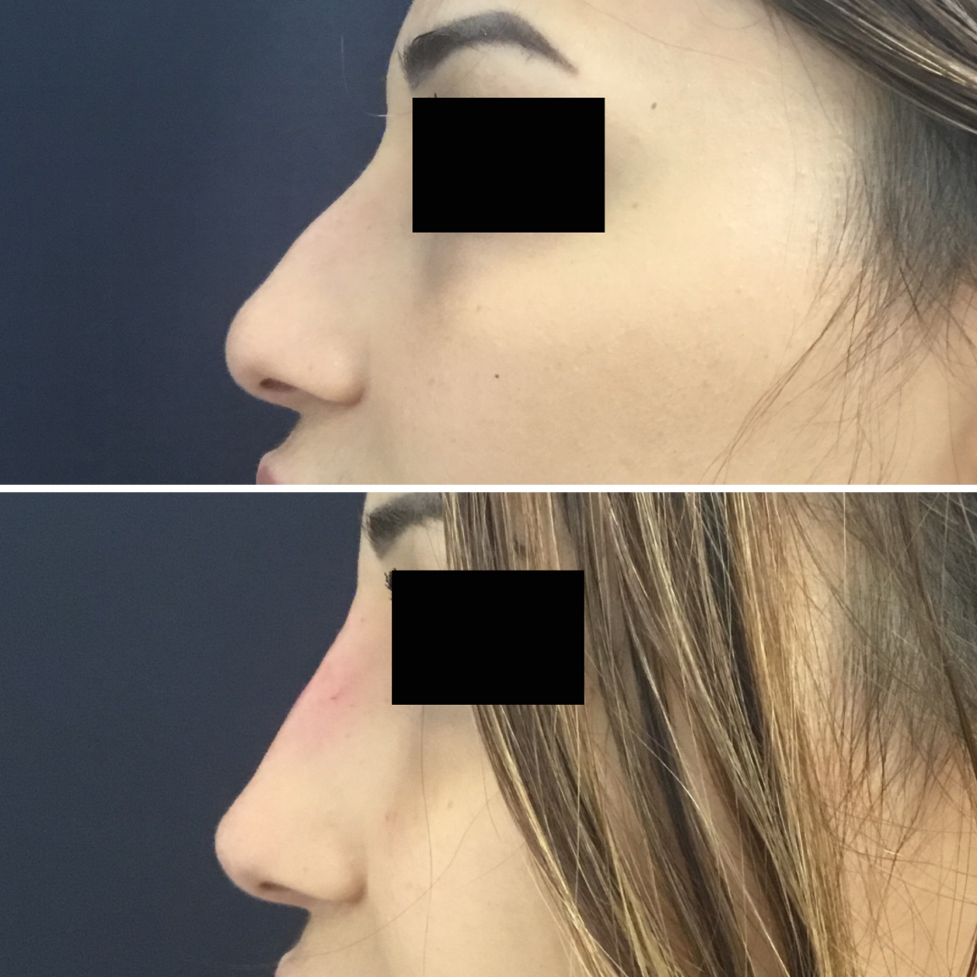 Subliminal nose results