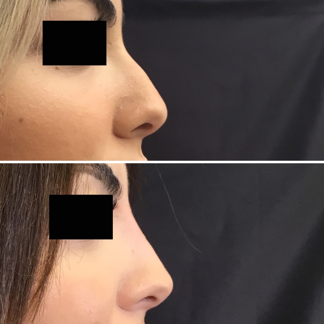 Subliminal nose results